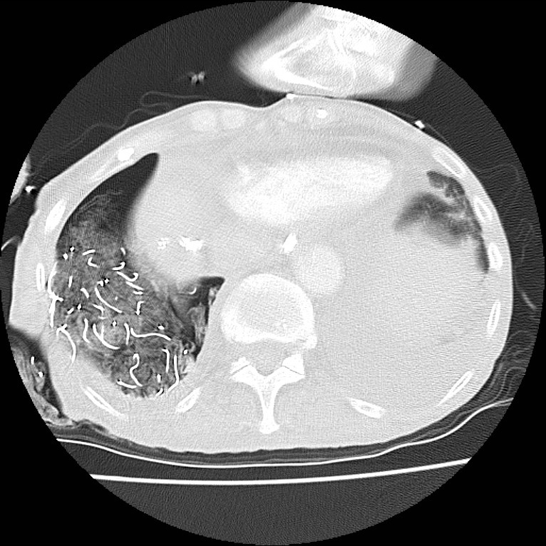 Clagett thoracotomy with bronchopleural fistula (Radiopaedia 29192-29587 Axial lung window 43).jpg