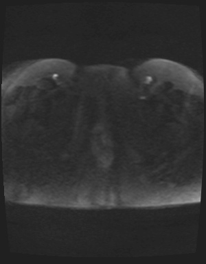 File:Class II Mullerian duct anomaly- unicornuate uterus with rudimentary horn and non-communicating cavity (Radiopaedia 39441-41755 Axial DWI 93).jpg