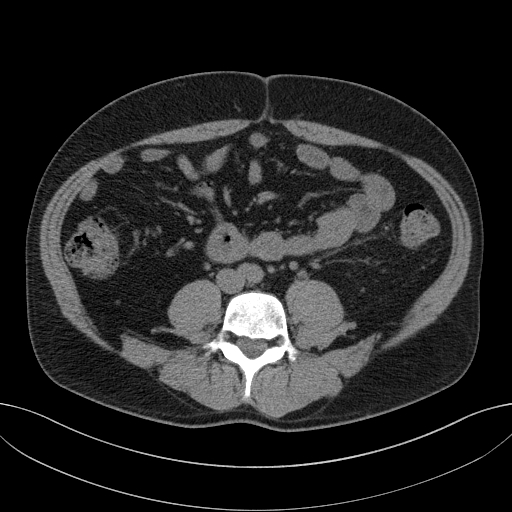 File:Clear cell renal cell carcinoma (Radiopaedia 61449-69393 Axial non-contrast 69).jpg