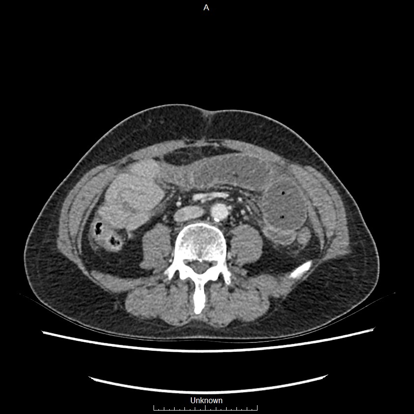 Closed loop bowel obstruction and ischemia (Radiopaedia 86959-103180 A 47).jpg