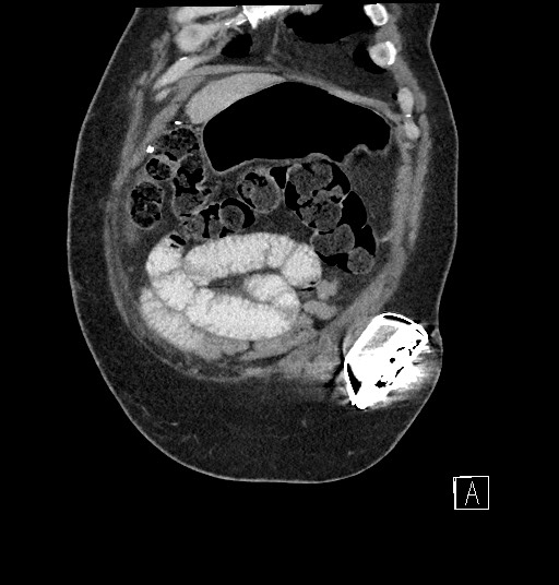 Closed loop obstruction - internal hernia into nephrectomy bed (Radiopaedia 59867-67320 B 12).jpg