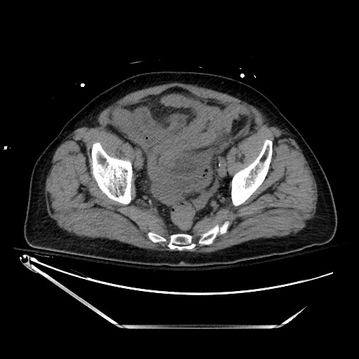 File:Closed loop obstruction due to adhesive band, resulting in small bowel ischemia and resection (Radiopaedia 83835-99023 Axial non-contrast 131).jpg