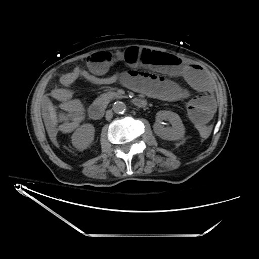 Closed loop obstruction due to adhesive band, resulting in small bowel ischemia and resection (Radiopaedia 83835-99023 Axial non-contrast 69).jpg