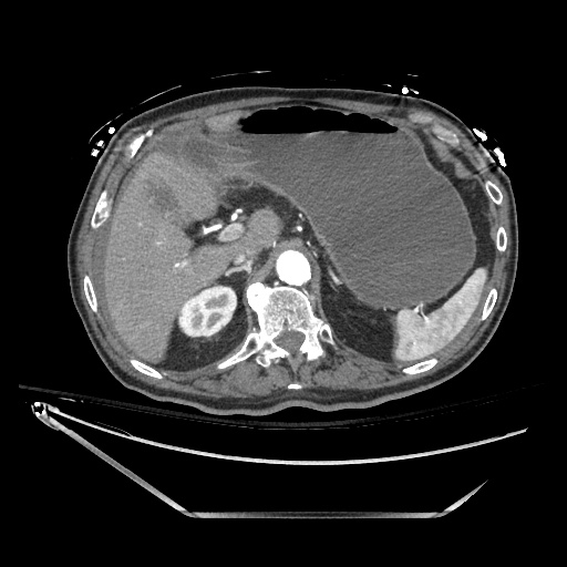 File:Closed loop obstruction due to adhesive band, resulting in small bowel ischemia and resection (Radiopaedia 83835-99023 B 41).jpg