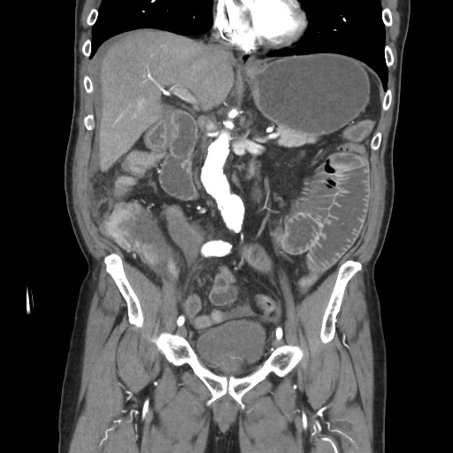 Closed loop obstruction due to adhesive band, resulting in small bowel ischemia and resection (Radiopaedia 83835-99023 C 60).jpg