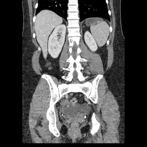 Closed loop small bowel obstruction (Radiopaedia 65403-74451 B 76).jpg