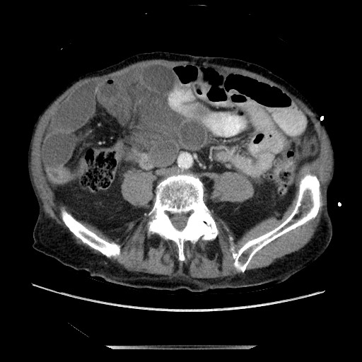 File:Closed loop small bowel obstruction - adhesive disease and hemorrhagic ischemia (Radiopaedia 86831-102990 A 120).jpg
