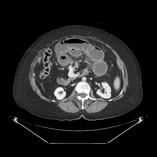 File:Closed loop small bowel obstruction - internal hernia (Radiopaedia 65402-74450 A 54).jpg