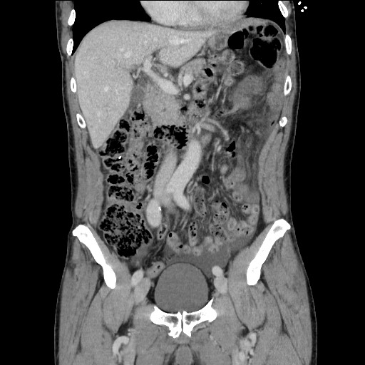 Closed loop small bowel obstruction - omental adhesion causing "internal hernia" (Radiopaedia 85129-100682 B 55).jpg