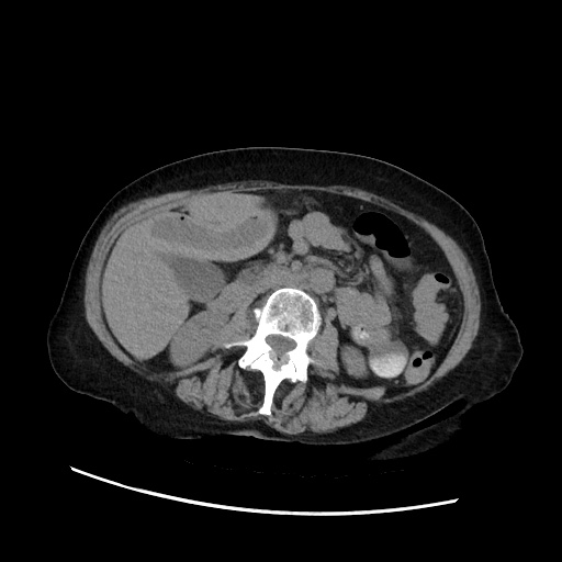 Closed loop small bowel obstruction due to adhesive band, with intramural hemorrhage and ischemia (Radiopaedia 83831-99017 Axial non-contrast 75).jpg