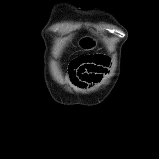Closed loop small bowel obstruction due to adhesive band - U-shaped loop (Radiopaedia 83829-99012 B 5).jpg