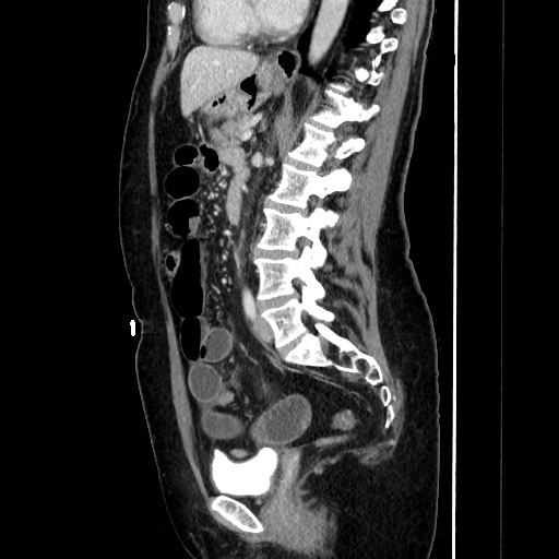 Closed loop small bowel obstruction due to adhesive bands - early and late images (Radiopaedia 83830-99015 C 101).jpg