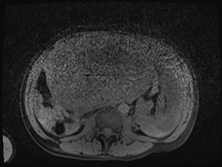 Closed loop small bowel obstruction in pregnancy (MRI) (Radiopaedia 87637-104031 F 3).jpg