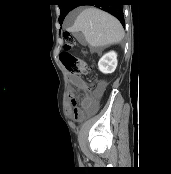 Closed loop small bowel obstruction with ischemia (Radiopaedia 84180-99456 C 23).jpg