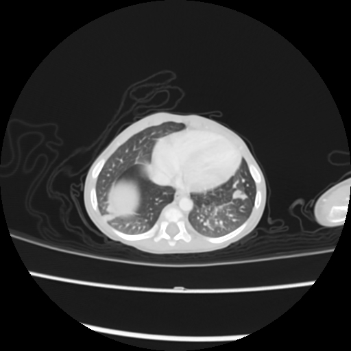 Coarctation of the aorta and patent ductus arteriosus (Radiopaedia 68033-77499 Axial lung window 49).jpg