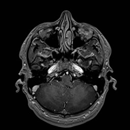 File:Cochlear incomplete partition type III associated with hypothalamic hamartoma (Radiopaedia 88756-105498 Axial T1 C+ 54).jpg