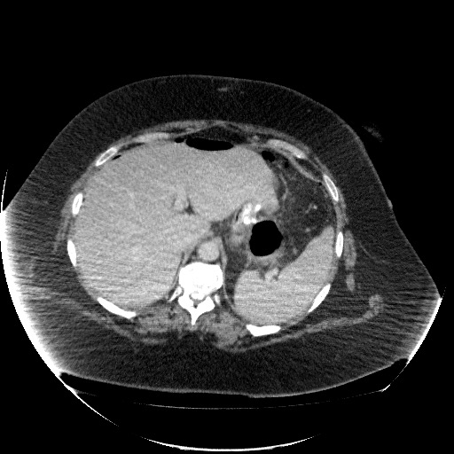 File:Collection due to leak after sleeve gastrectomy (Radiopaedia 55504-61972 A 21).jpg