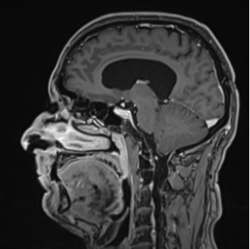 File:Colloid cyst of the third ventricle (Radiopaedia 86571-102662 Sagittal T1 C+ 44).png