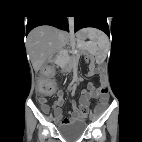 File:Colocolic fistula - Crohn disease (Radiopaedia 57063-63955 B 20).jpg