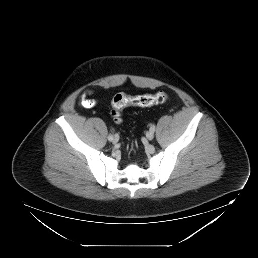 File:Colocolic intussusception due to lipoma (Radiopaedia 73712-84508 Axial 94).jpg