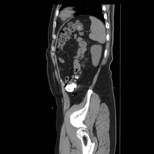 Colocutaneous fistula in Crohn's disease (Radiopaedia 29586-30093 F 45).jpg