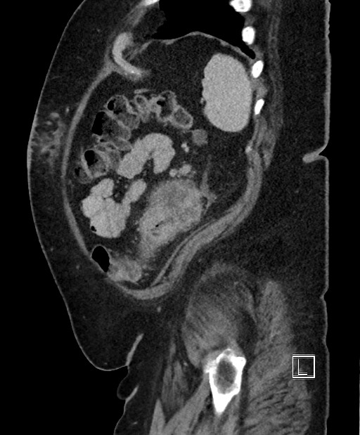 Colon adenocarcinoma (Radiopaedia 59374-66735 C 15).jpg