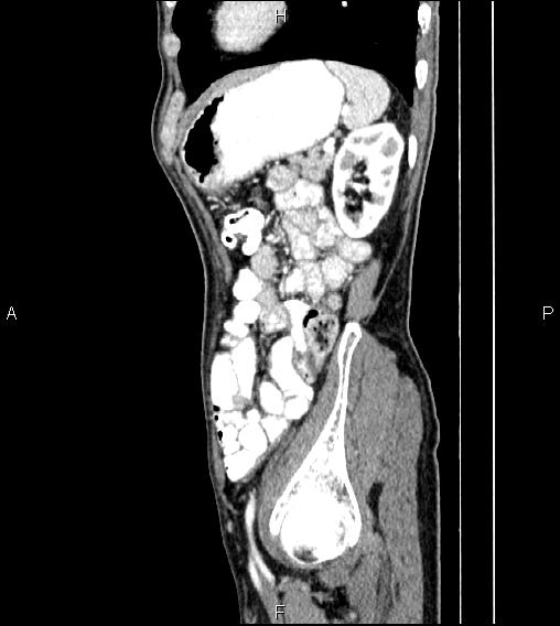 File:Colon adenocarcinoma - hepatic flexure (Radiopaedia 85635-101395 D 70).jpg