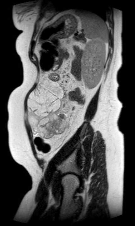 Colon adenocarcinoma with Krukenberg tumors, advanced pregnancy (Radiopaedia 67279-76645 Sagittal T2 14).jpg