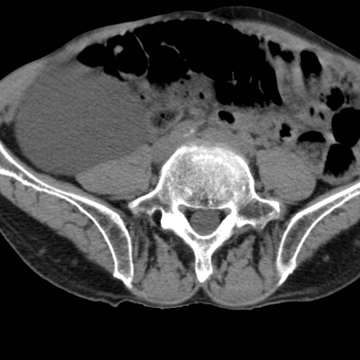 Colon cancer with calcified liver metastasis (Radiopaedia 74423-85309 Axial non-contrast 72).jpg
