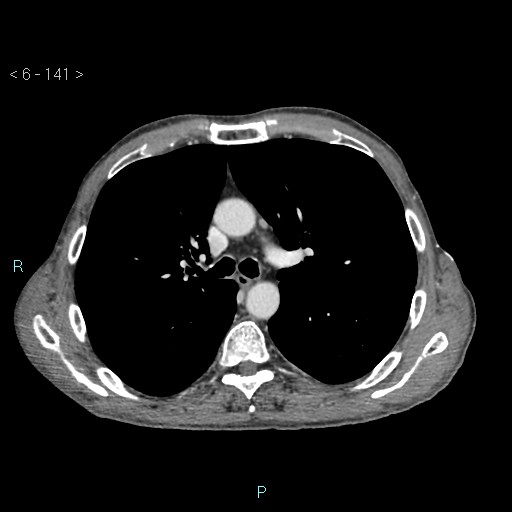 File:Colonic cancer (ultrasound and TC imaging) (Radiopaedia 50346-55713 B 141).jpg