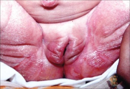 File:Congenital syphilis. Erosive lesion over genitals.png