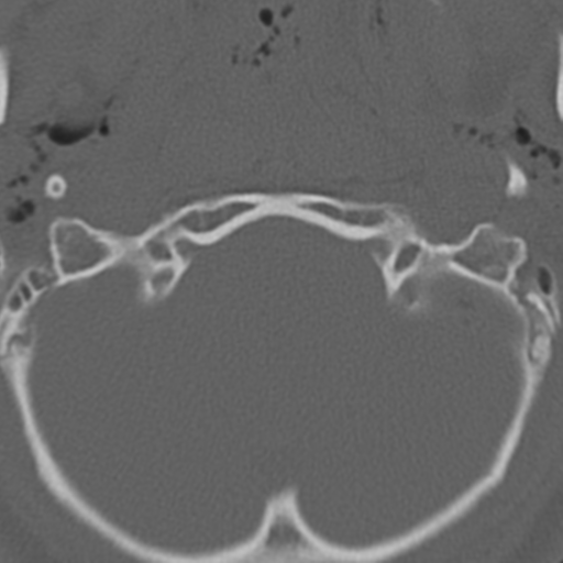 File:Multitrauma with diffuse axonal injury, temporal bone fractures and traumatic caroticocavernous fistula (Radiopaedia 37242-39035 Axial 229).png