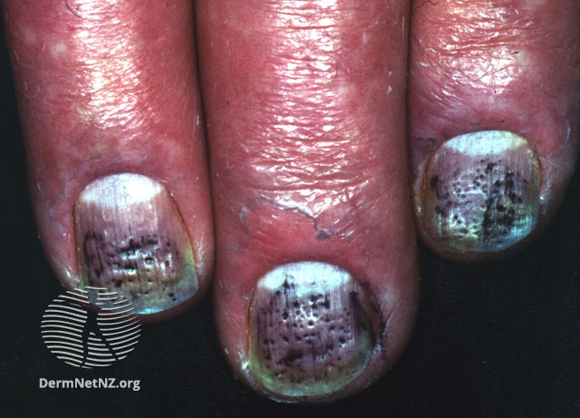File:Nails in psoriasis (DermNet NZ scaly-pits-ps).jpg