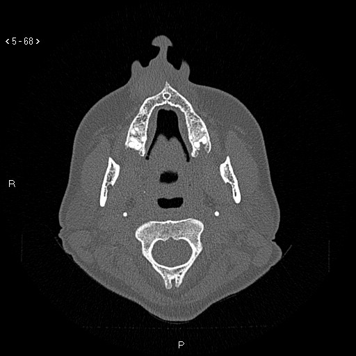 Nasolabial cyst (Radiopaedia 75125-86194 Axial bone window 29).jpg