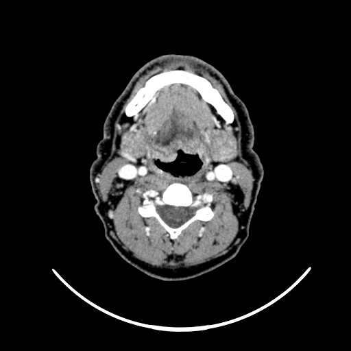 File:Nasopharyngeal carcinoma - infiltrating the clivus (Radiopaedia 62583-70875 Axial Post contrast 41).jpg