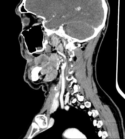File:Nasopharyngeal carcinoma - infiltrating the clivus (Radiopaedia 62583-70875 C 35).jpg