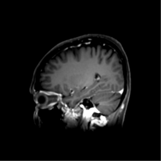 File:Nasopharyngeal carcinoma with cerebral abscess (Radiopaedia 43018-46274 J 38).png