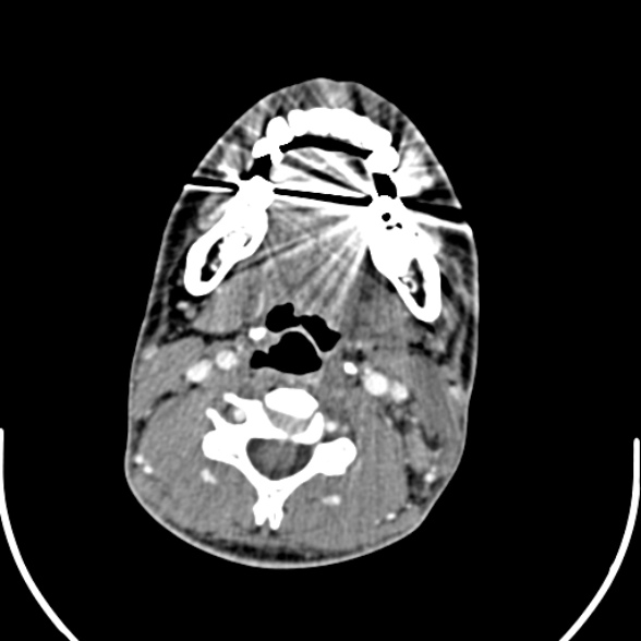 File:Nasopharyngeal carcinoma with skull base invasion (Radiopaedia 53415-59705 A 116).jpg