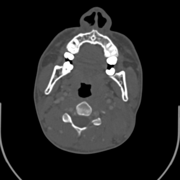 Nasopharyngeal carcinoma with skull base invasion (Radiopaedia 53415-59705 Axial bone window 93).jpg
