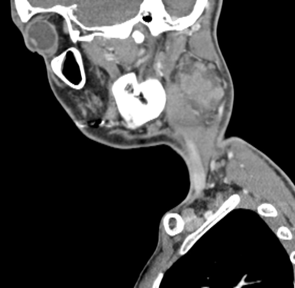Nasopharyngeal carcinoma with skull base invasion (Radiopaedia 53415-59705 C 58).jpg