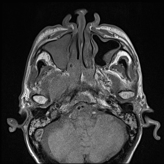 File:Nasopharyngeal carcinoma with skull base invasion (Radiopaedia 59258-66600 B 17).jpg