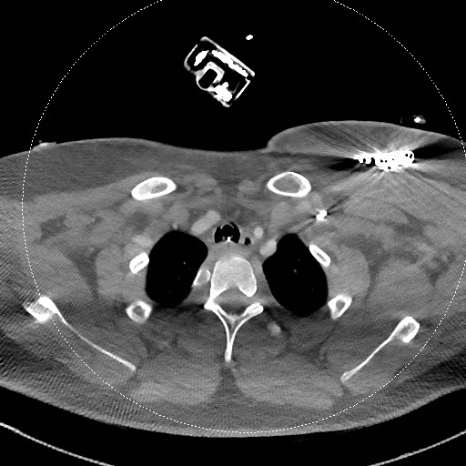 Neck CT angiogram (intraosseous vascular access) (Radiopaedia 55481-61945 B 92).jpg