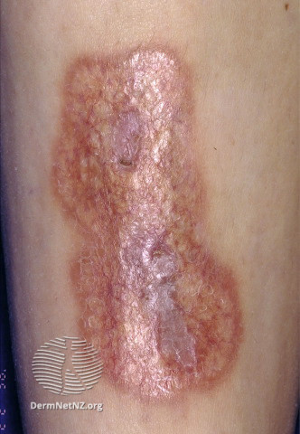 File:Necrobiosis lipoidica (DermNet NZ vascular-s-telangiectases-09).jpg