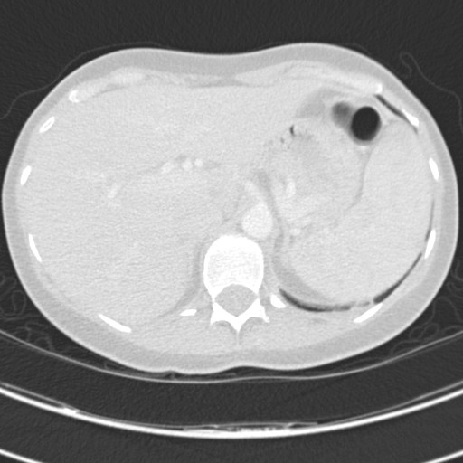 Necrobiotic pulmonary nodules - Crohn disease (Radiopaedia 20723-20631 Axial lung window 137).jpg