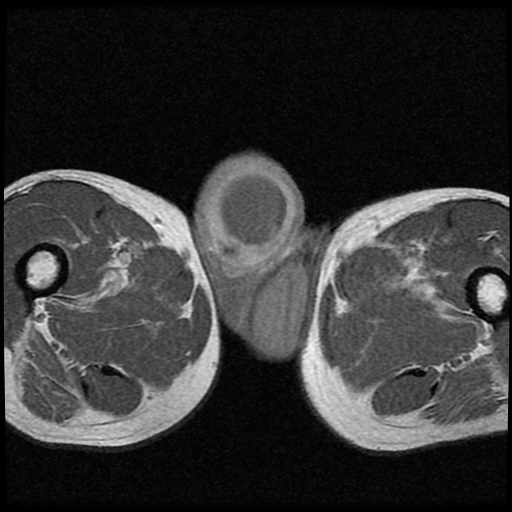 File:Necrotizing epididymo-orchitis with intra-testicular abscess (Radiopaedia 29397-29860 Axial T1 C+ 15).jpg