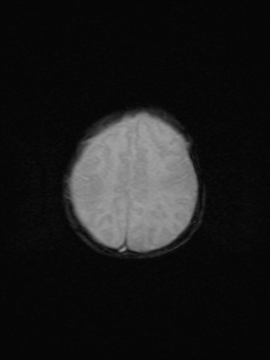 File:Neonatal hypoxic-ischemic encephalopathy (Radiopaedia 41406-44277 Axial Gradient Echo 5).jpg