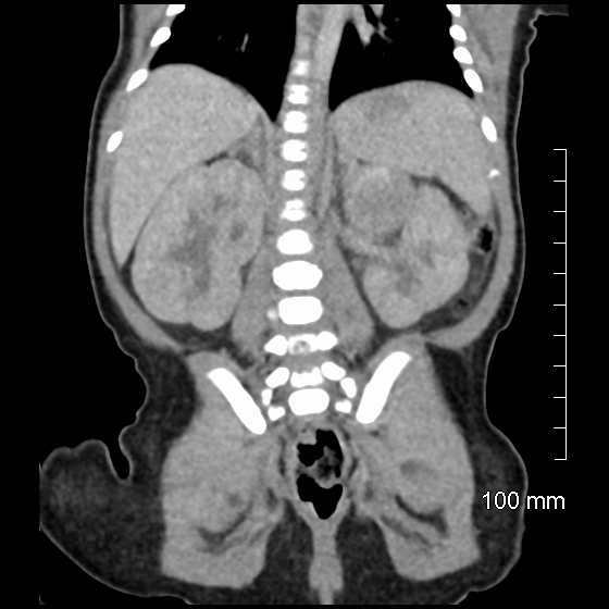 File:Neonatal neuroblastoma (Radiopaedia 56651-63438 Coronal non-contrast 35).jpg