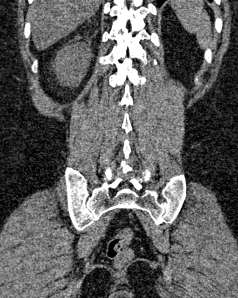 File:Nephrostomy for urosepsis (Radiopaedia 26180-26330 non-contrast 71).jpg