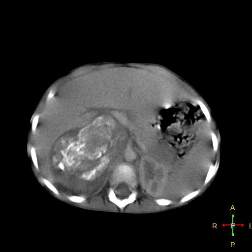 File:Neuroblastoma (Radiopaedia 24751-25016 D 11).jpg
