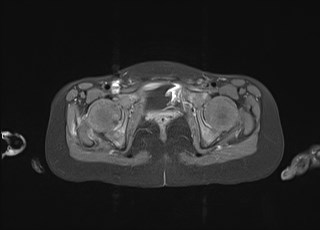 File:Neuroblastoma with bone metastases (Radiopaedia 67080-76414 Axial T1 C+ fat sat 47).jpg